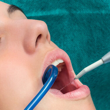 A lady having root canal