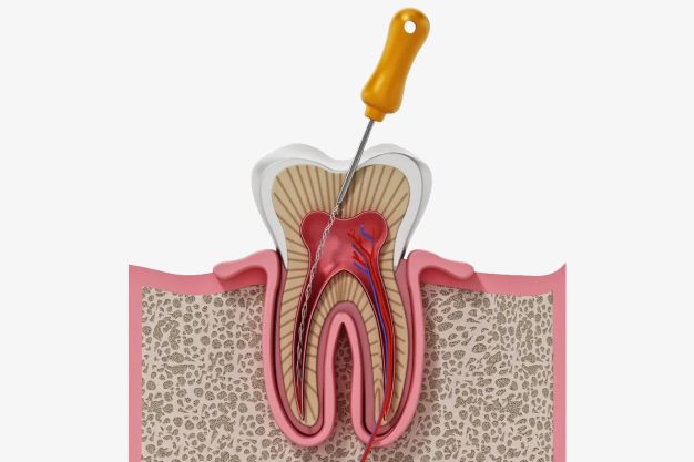 Tratamiento de conducto radicular