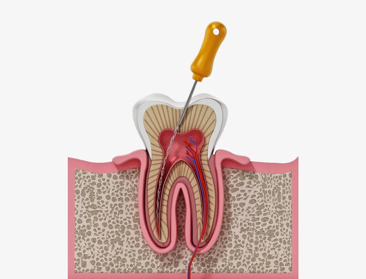 Root Canal Treatment