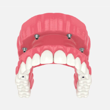 All-on-4 Dental Implants Model