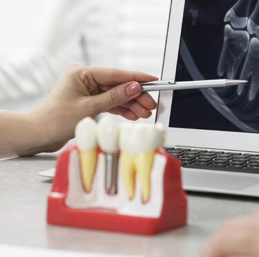 The Dental Implant Process Dentist Pearland TX