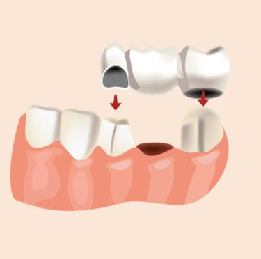 Procedimiento de puente dental en Pearly Whites of Pearland, dentista familiar en Pearland TX.