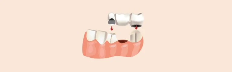 Procedimiento de puente dental en Pearly Whites of Pearland, dentista familiar en Pearland TX.