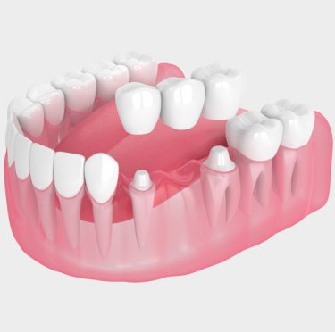 Modelo 3D de dientes humanos, consultorio dental Pearly Whites de Pearland.