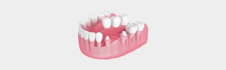 Modelo 3D de dientes humanos, consultorio dental Pearly Whites de Pearland.