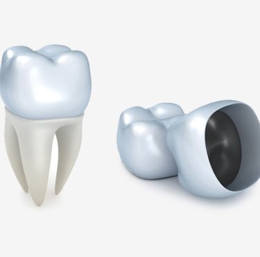 Coronas dentales en Pearly Whites of Pearland, su dentista familiar en Pearland TX.