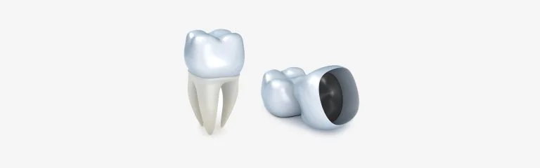 Coronas dentales en Pearly Whites of Pearland, su dentista familiar en Pearland TX.