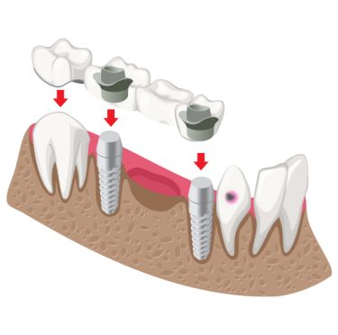 Procedimiento de implante dental en Pearly Whites of Pearland, dentista Pearland TX.
