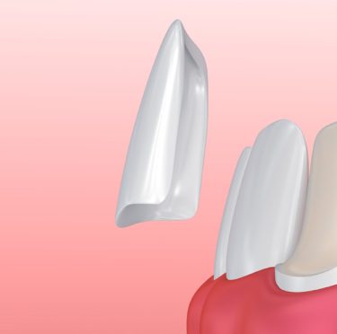 Aplicación de carillas dentales en Pearly Whites of Pearland, dentista en Pearland TX.