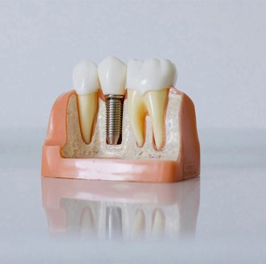 Modelo de implante dental en Pearly Whites of Pearland, dentista familiar y atención de emergencia en Pearland, TX.