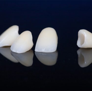 Coronas dentales en Pearly Whites of Pearland, dentista en Pearland TX.