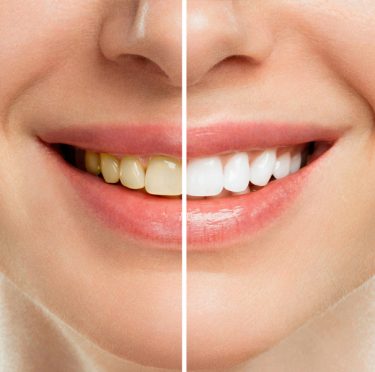 Before and after dental treatment at Pearly Whites of Pearland.