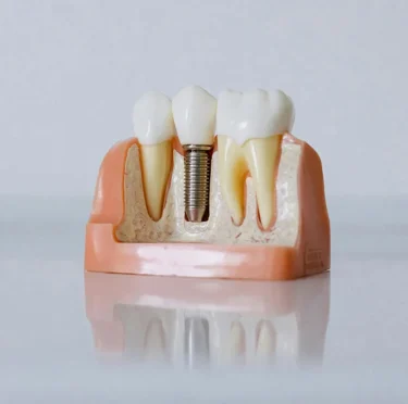 Dental implant model at Pearly Whites of Pearland, dentist in Pearland TX.