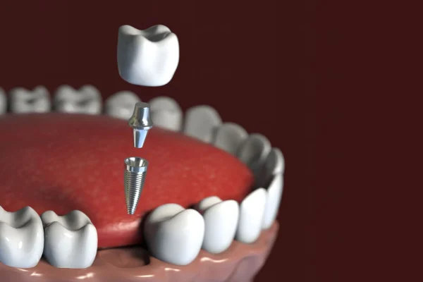 implantes dentales blancos perlados 2880w